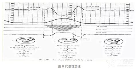 胎心减速