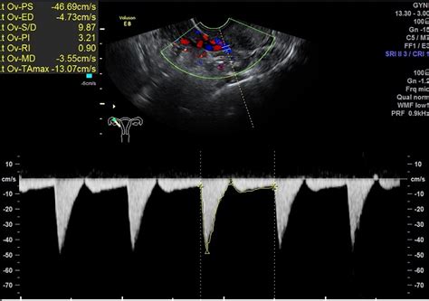 子宫动脉b超多少钱