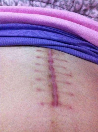 剖腹产刀疤好几年了突然感觉很痒