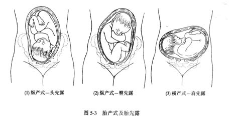 臀位对胎儿的危害