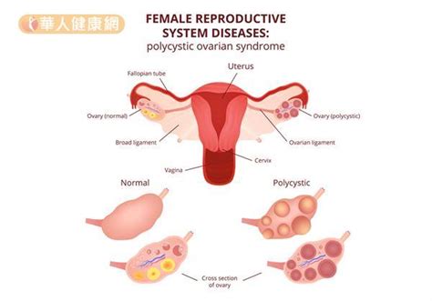 多囊性卵巢症影响怀孕