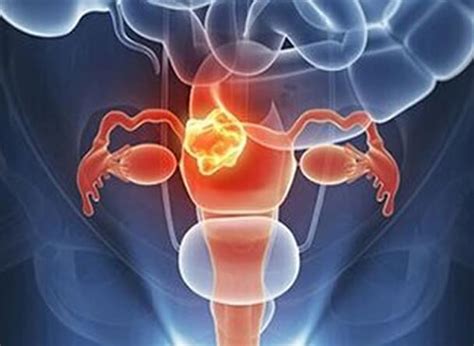 卵巢囊肿有什么危害