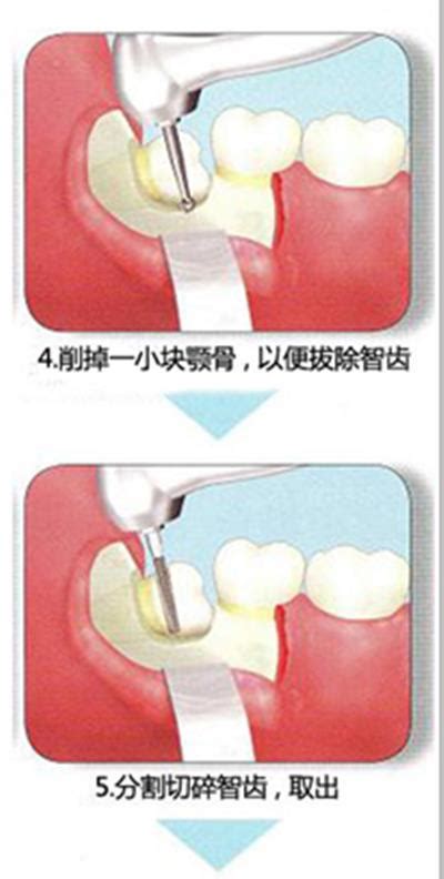 发臭的假牙去拔牙贵吗