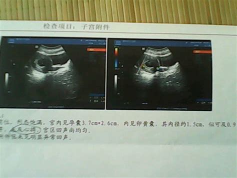 孕6周有卵黄囊未见胎心胎芽