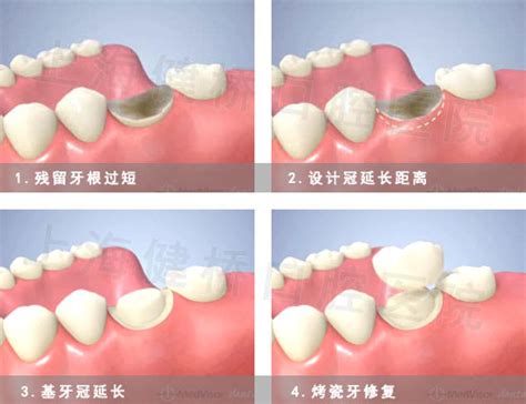树脂假牙一般能用多久