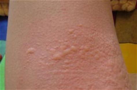 幼儿急性荨麻疹一般几天会消退