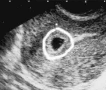 怀孕47天未见卵黄囊一般正常吗