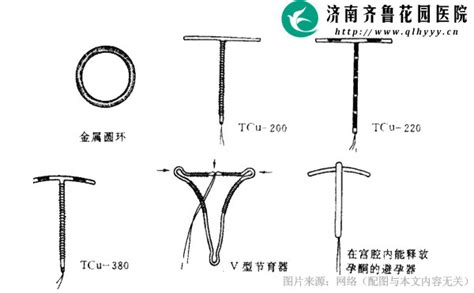 自从带上避孕环例假就不正常