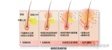 长痘喝全脂还是脱脂