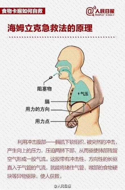 海姆立克急救法儿童