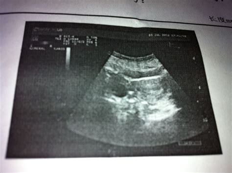14周的胎儿b超图片