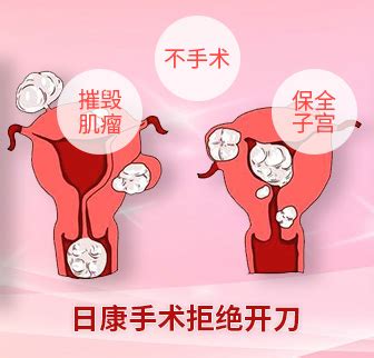 怀孕宫腔积液饮食注意什么