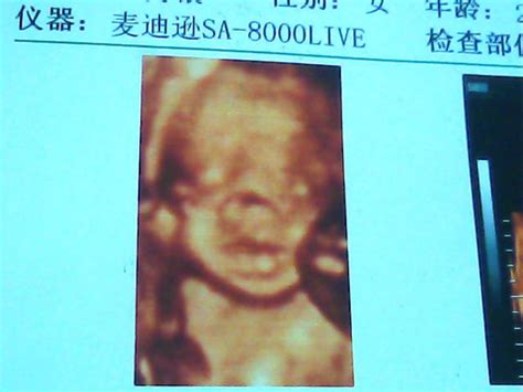 怀孕24周胎儿彩超图片