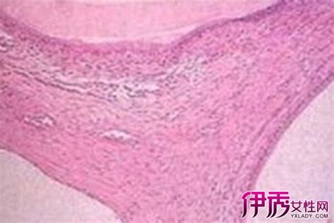 卵黄囊肿最佳治疗方法