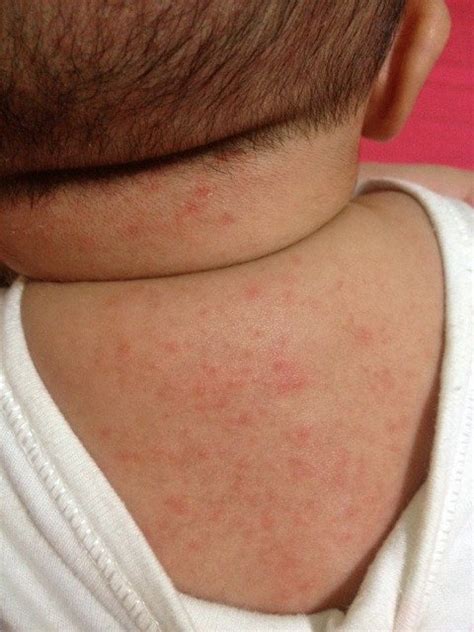 宝宝包茎是怎么引起的