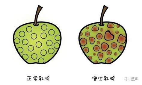 怀孕期间乳房刺痛是什么原因