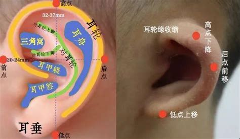 四维发现宝宝右耳畸形