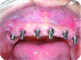 假牙的安装过程