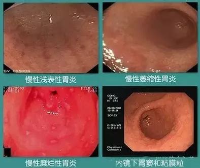 胃上部心窝处堵憋难受打嗝就好点