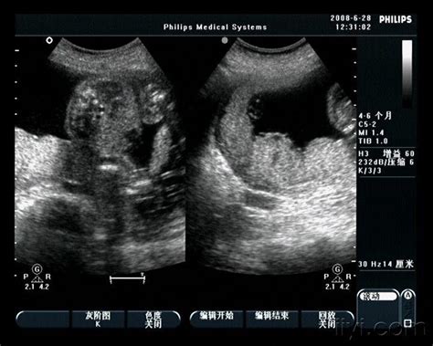 怀孕100天胎儿图片库