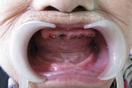 孕妇牙龈肿痛可以输液吗