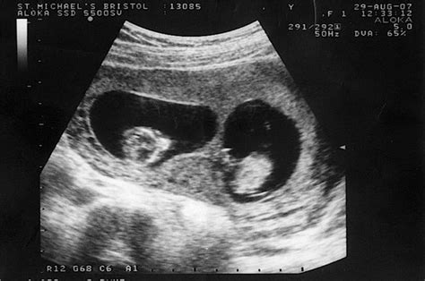 怀孕双胞胎15天b超图片真实