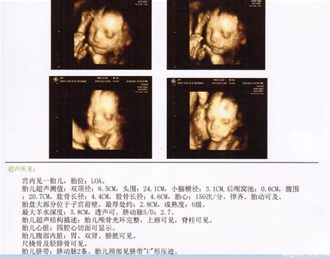 怀孕五周胎儿真实图片