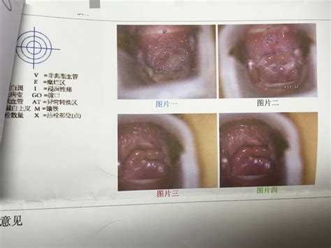 怀孕后白带粘稠怎么回事