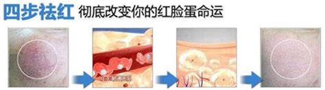 维生素c治疗红血丝有效果吗