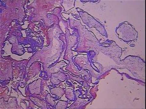 二胎瘢痕子宫破裂前兆是什么