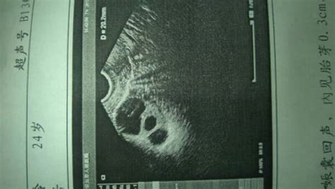 怀孕两个月的b超孕囊图