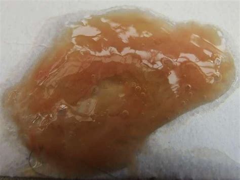 痰里有黄色的絮状物