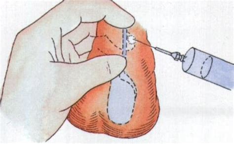 男性结扎