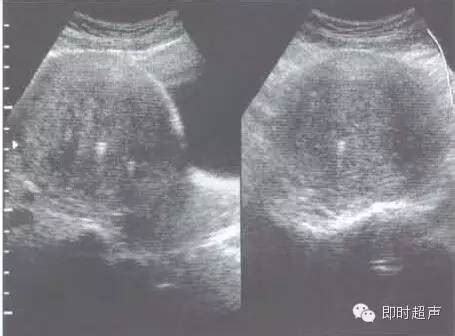 腺肌症一般哪里痛