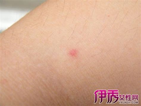 热毒皮肤症状图