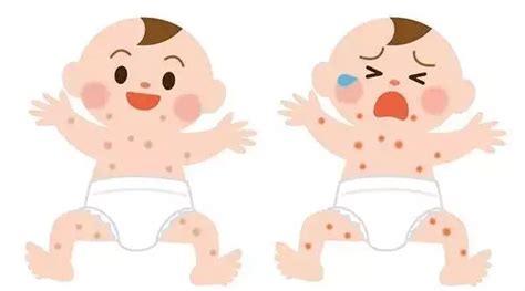 婴儿湿疹与脂溢性皮炎的区别