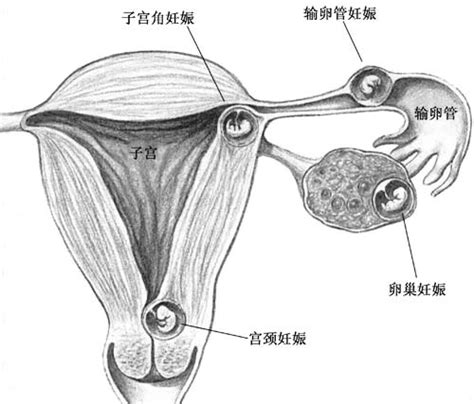 怀孕30天怎么确定宫外孕