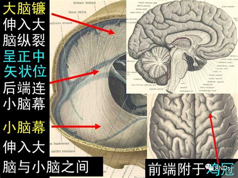 侧脑室15mm必须引产吗