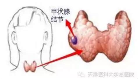 吃海帶可以治療甲狀腺腫大嗎