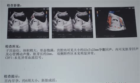 怀孕3周胎儿图片大全