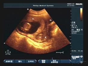 孕期胎盘植入有哪些症状