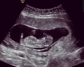 孕12周胎儿真实图