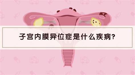 如何判斷子宮內膜異位症