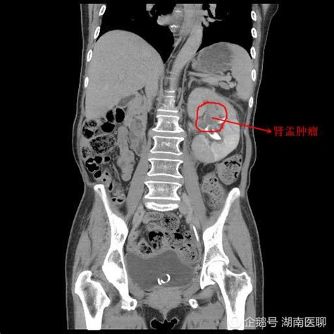 为什么肾盂分离是男孩几率大