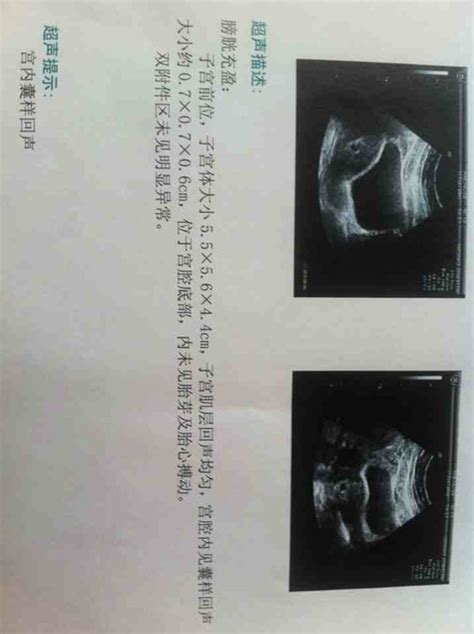孕23周胎儿腹围标准值