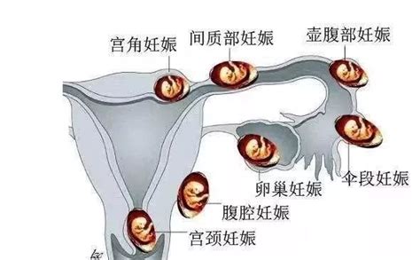 宫腔镜后最佳怀孕时间