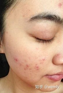 夏天总是长痘痘怎么办
