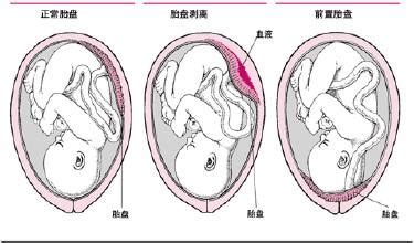 球拍状胎盘是怎么形成的原因