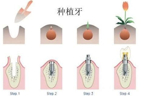 种植牙齿什么时候纳入医保