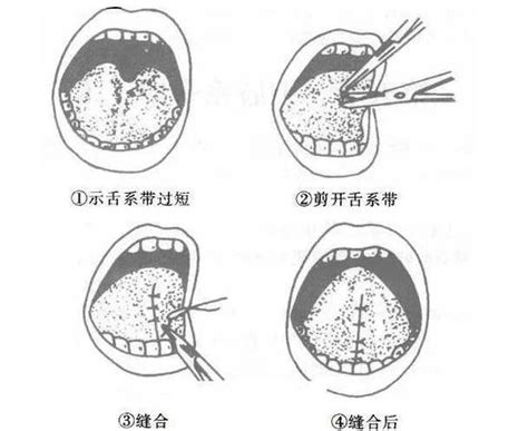 怎么判断宝宝要不要剪舌系带